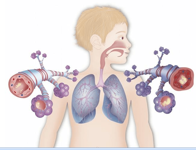 Бронхиальная астма у детей