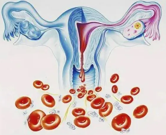 Ановуляторное маточное кровотечение