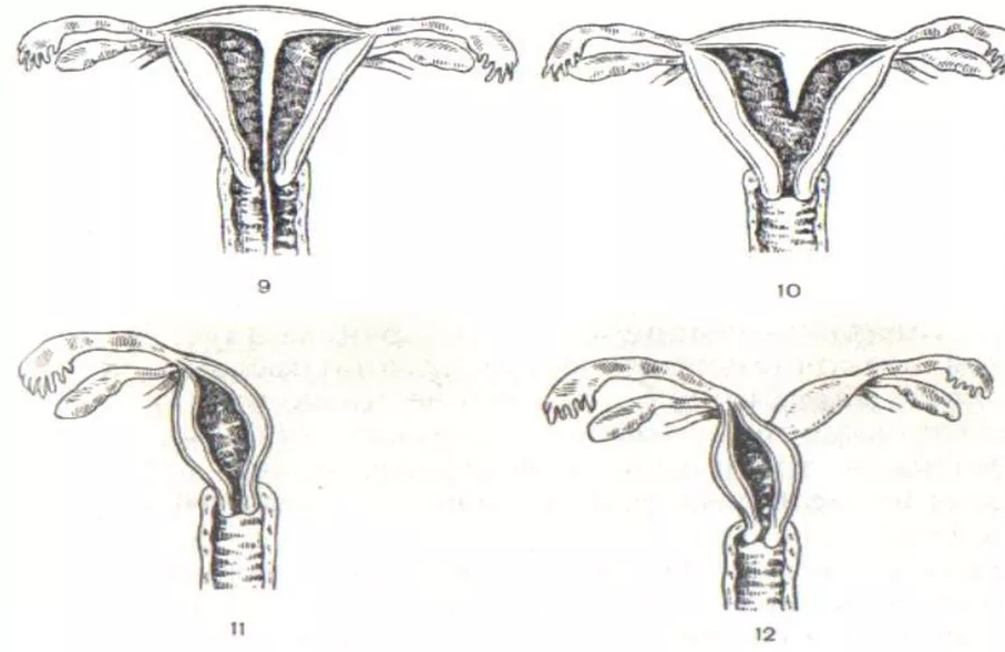 Аномалии женских половых органов
