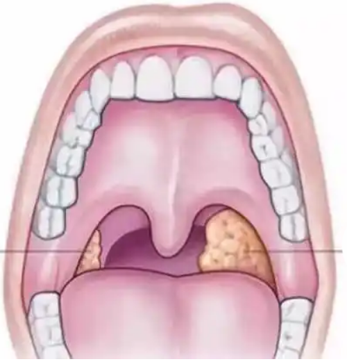 Аденоидит у детей